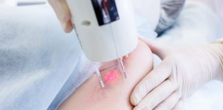 8 things to know before having laser treatment for your scar