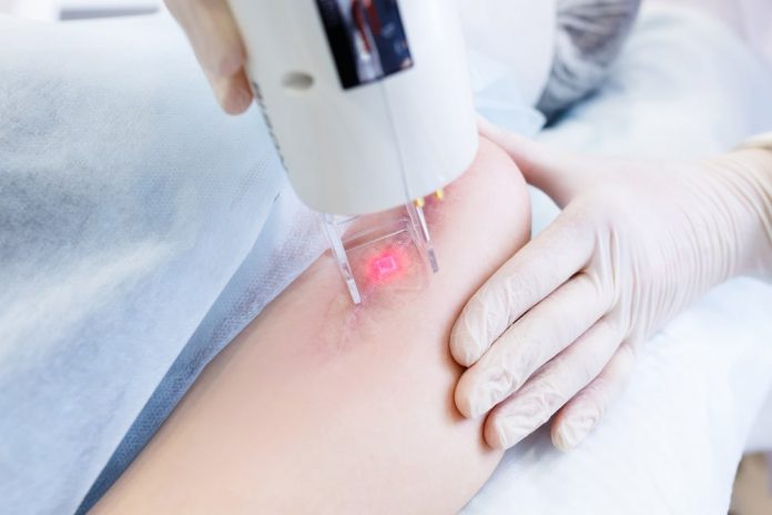 8 things to know before having laser treatment for your scar