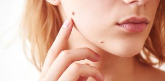 Just Had Wart or Mole Removal Here’s What To Do Next
