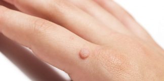 What Is A Wart And How To Spot One