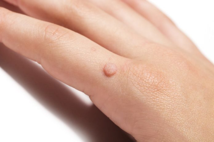 What Is A Wart And How To Spot One