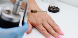warts removal