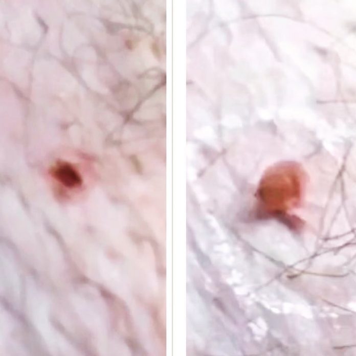 genital skin tags removal at home