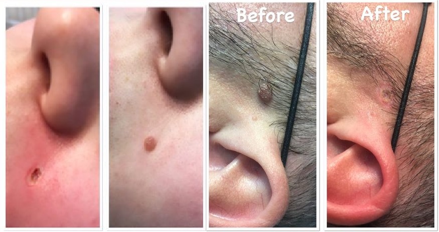 MOLE REMOVAL PEN BEFORE AND AFTER UPDATE // New Mole and Skin Tag