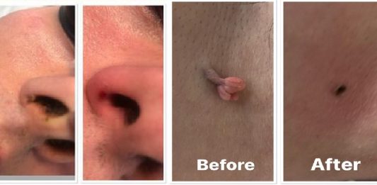 skin tag removal