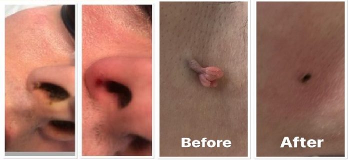 skin tag removal