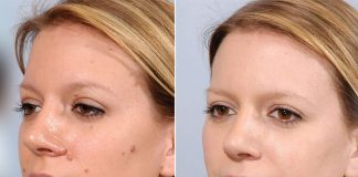 Mole removal before and after