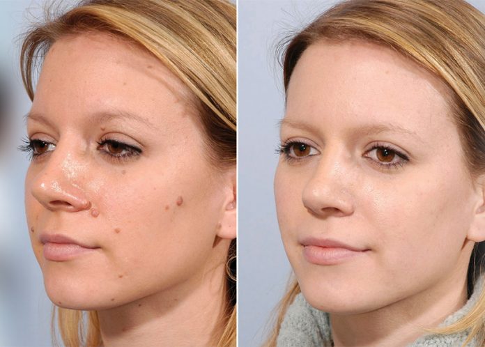 Mole removal before and after