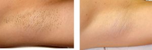 is-laser-hair-removal-painful