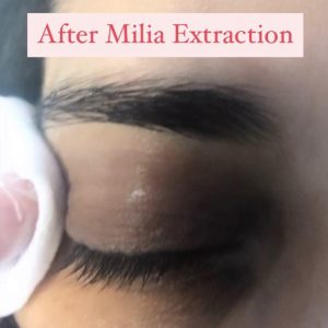 after-milia-extraction