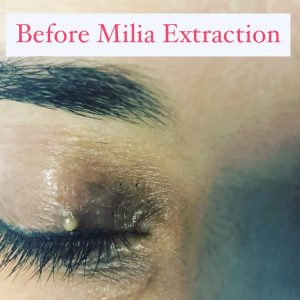 before-milia-extraction