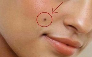 how-does-mole-looks