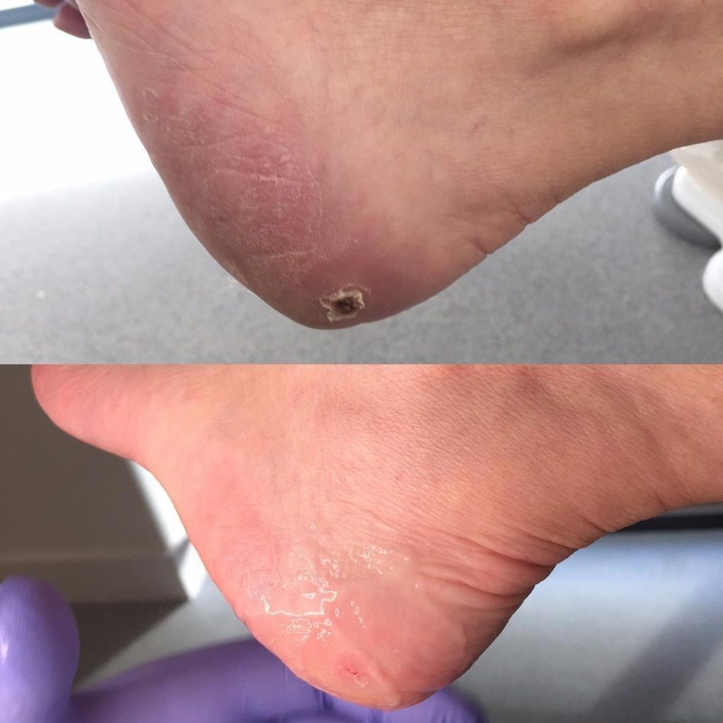 What Does VERRUCAS Mean? Find All The Treatment Options of Verrucas