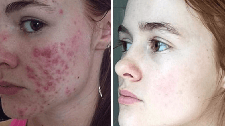 Acne Treatment - Perfection Cosmetic