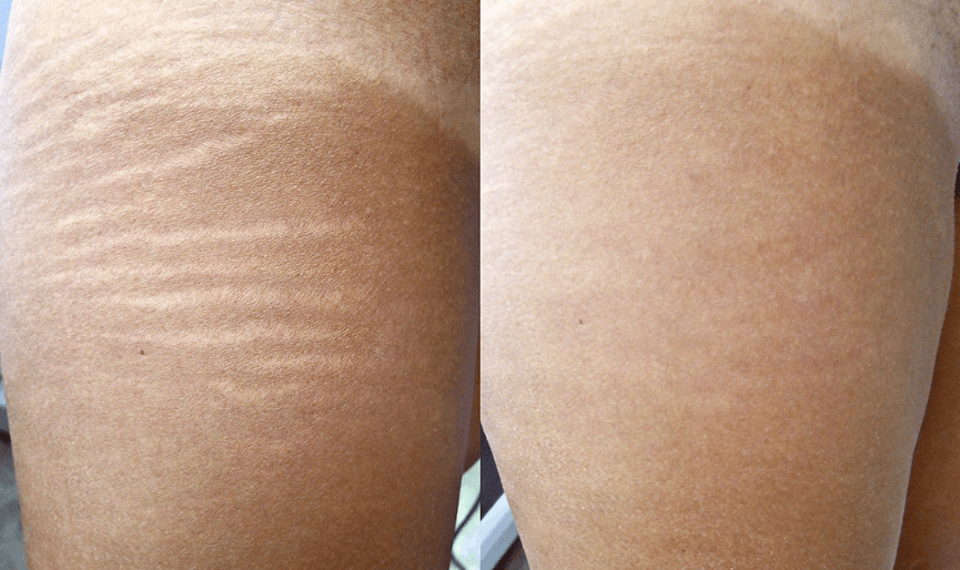 Stretch Mark Reduction Treatment - Perfection Cosmetic