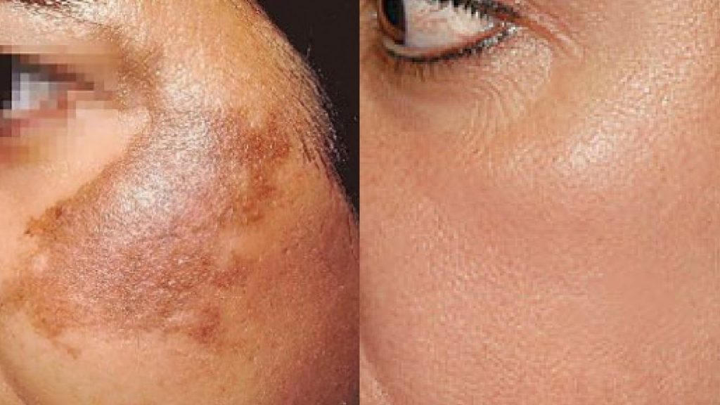 Pigmentation / Melesma / Sun Spots Treatment - Perfection Cosmetic