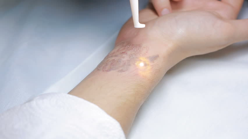 laser tattoo removal
