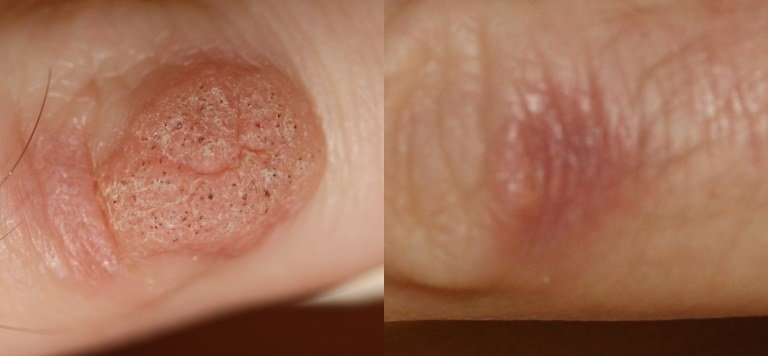 warts removal