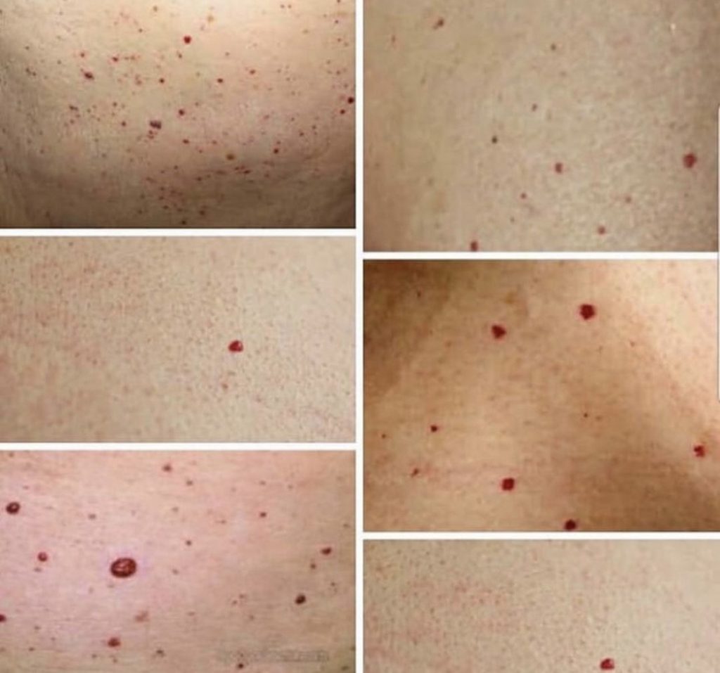 Laser Mole Removal Plasma Pen Mole Removal Treatment in Bolton