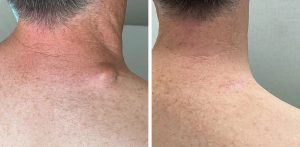 sebaceous cyst removal