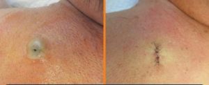 sebaceous cyst